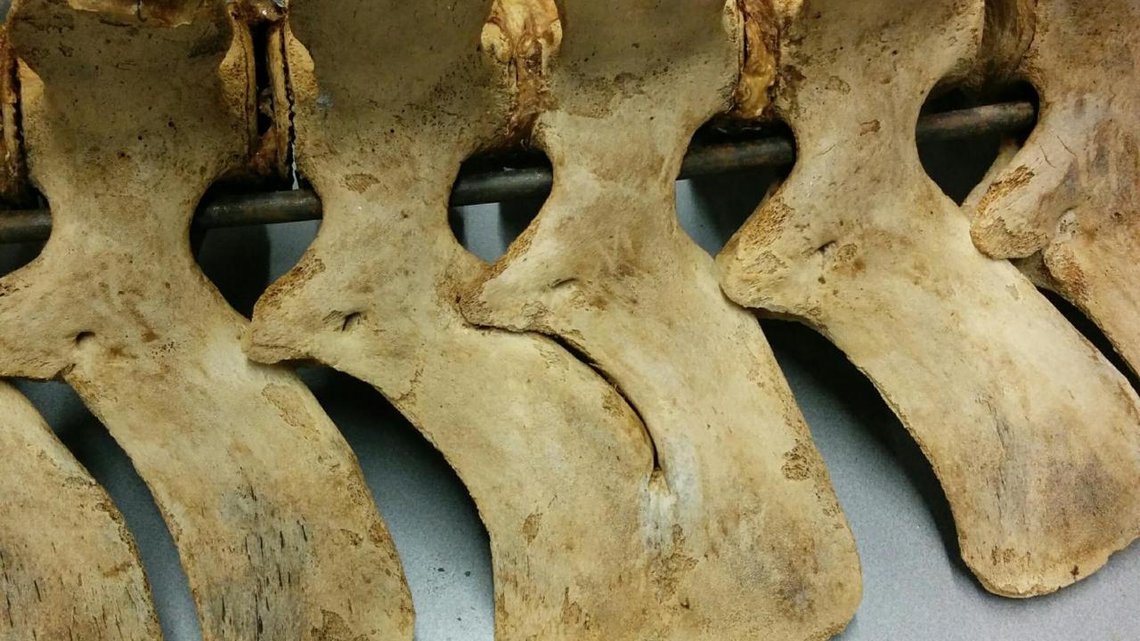 gefuseerde ruggenwervels